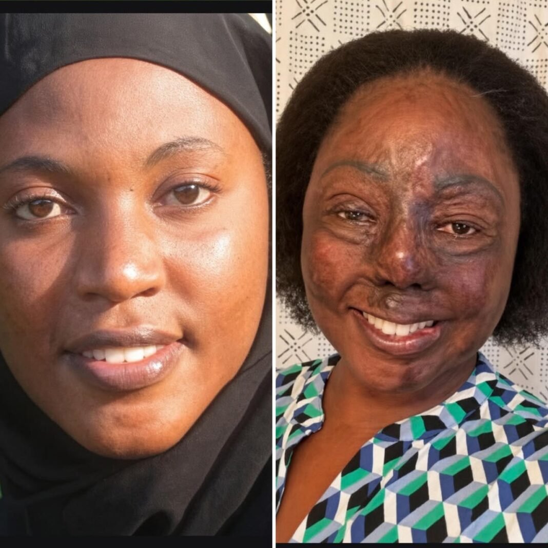 After the Acid Attack, Hanifa Chose Courage Over Silence After the Acid Attack, Hanifa Chose Courage Over Silence